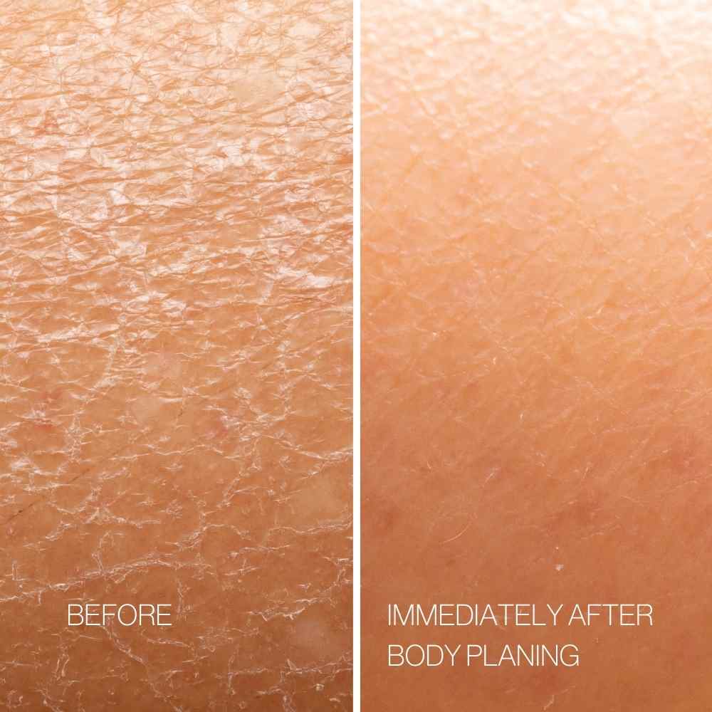 Skin texture before and immediately after exfoliating body planning