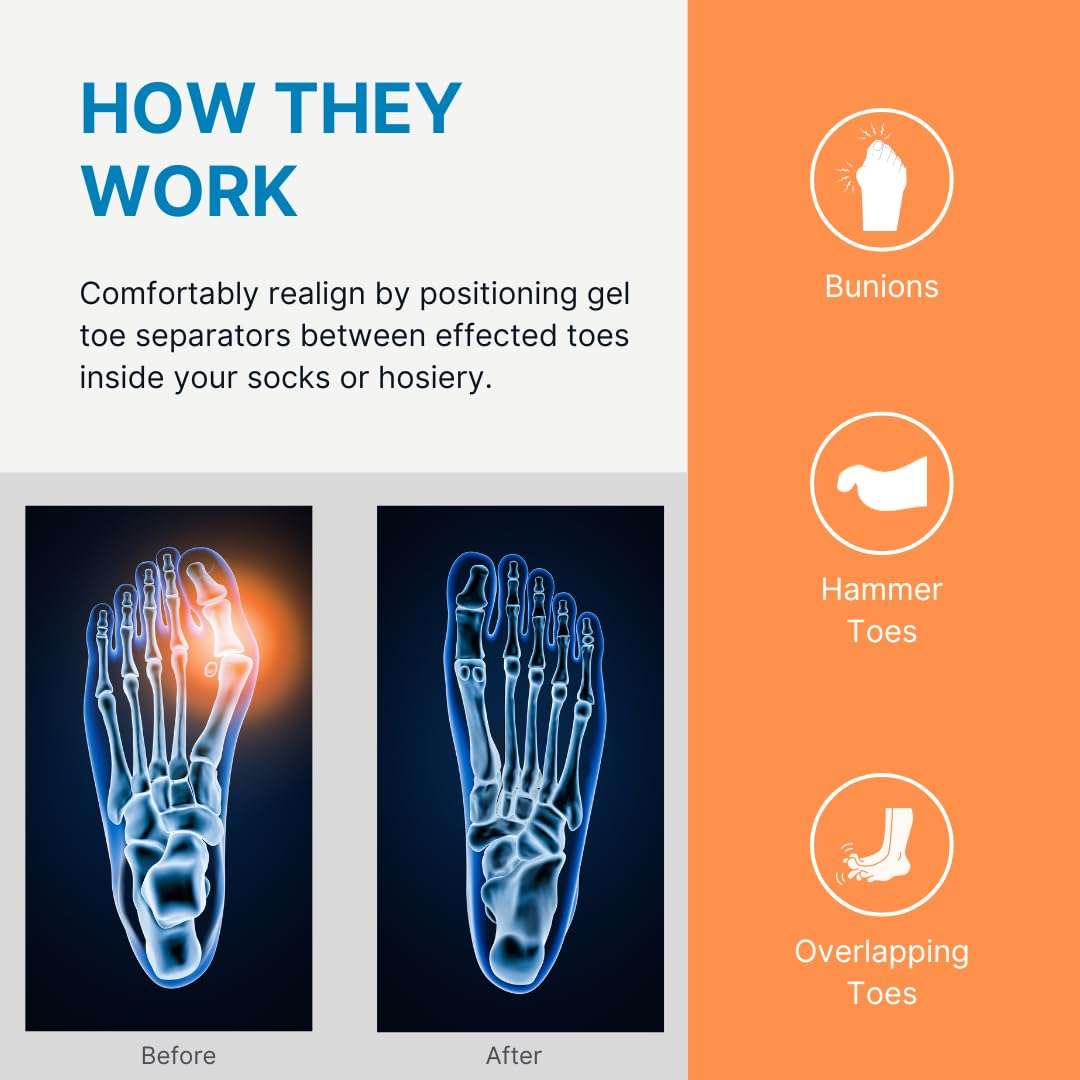 Gel toe separator pads positioned between toes for alignment