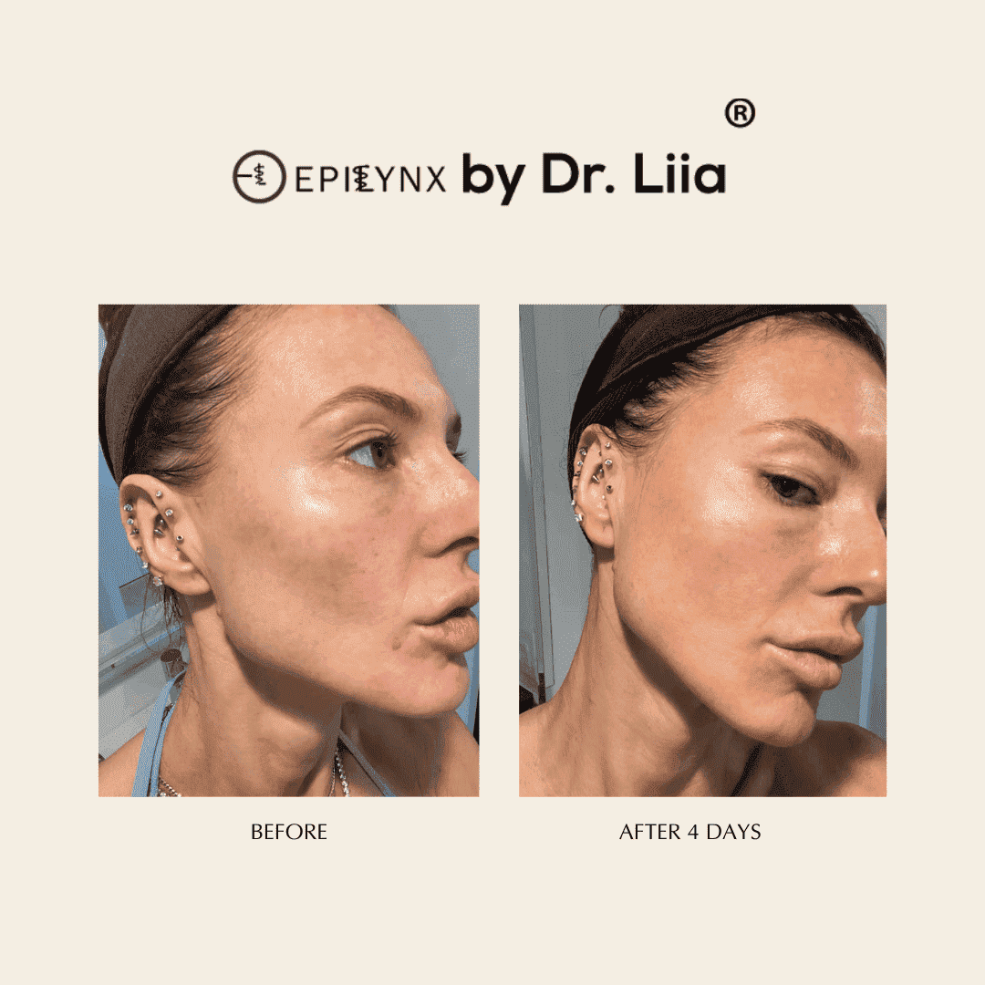 Serum after-usage skincare comparison: two side-profile faces labeled before and after